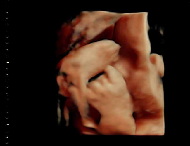 3D ultrasound image at 31 weeks